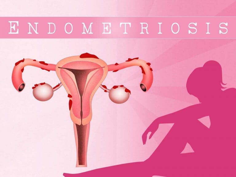 Recovery for Endometriosis Surgery
