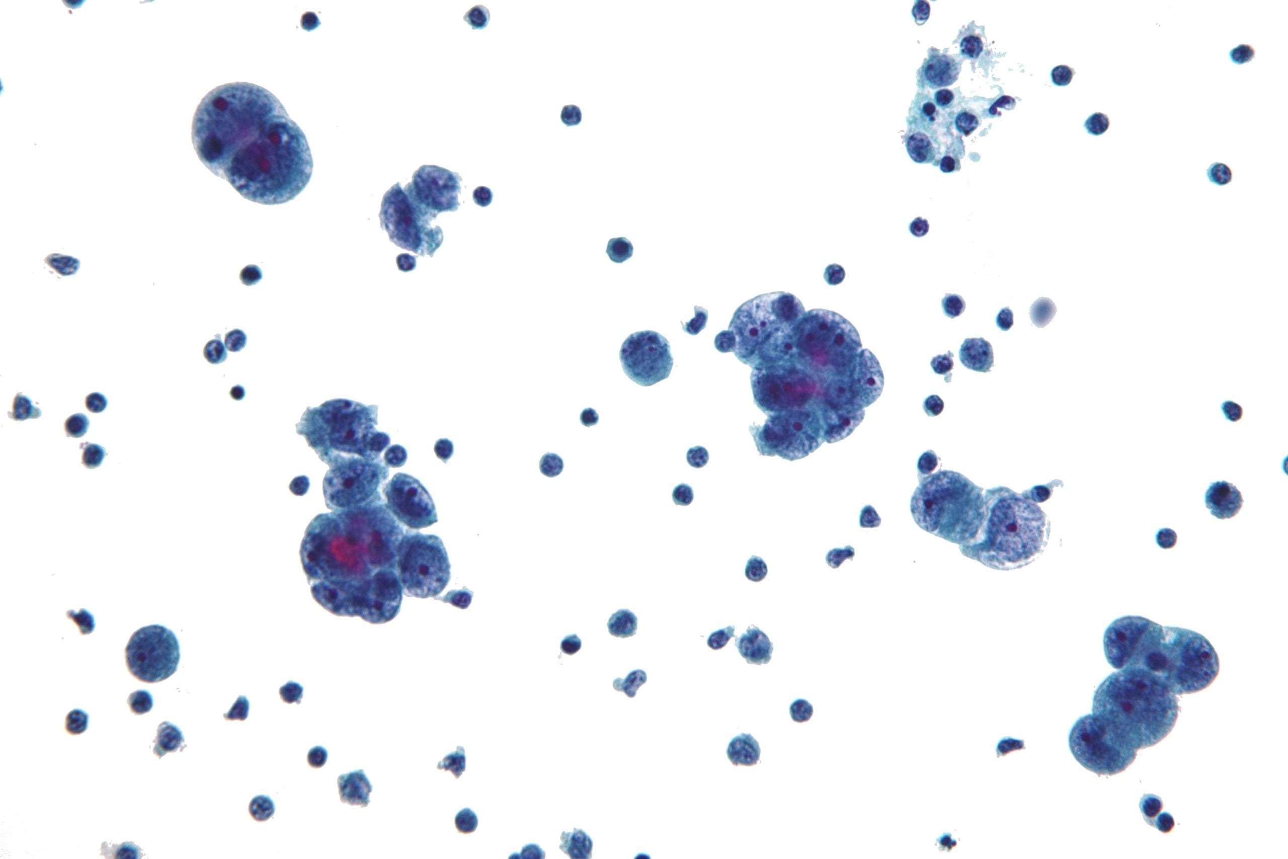 primary peritoneal carcinoma