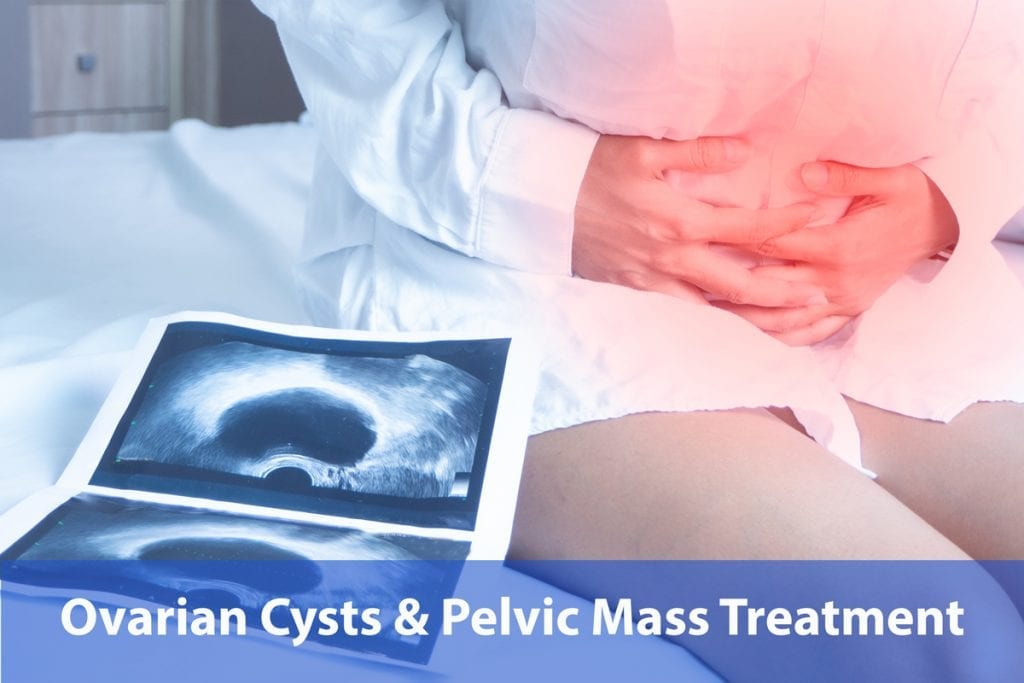 ovarian cyst pelvic mass