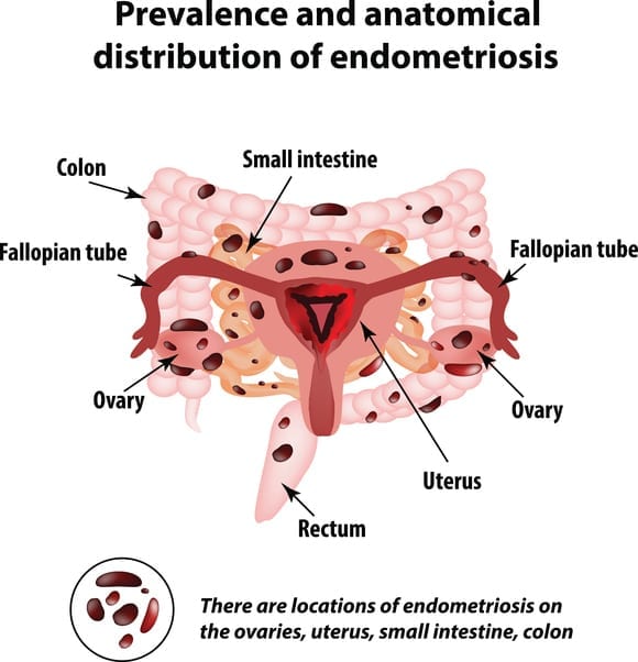 endometriosis distribution
